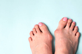 Wat is Hallux Valgus?